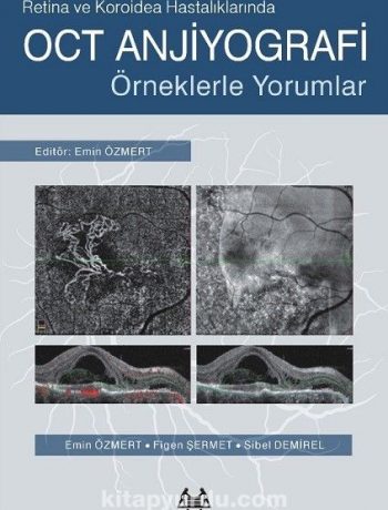 Retina ve Koroidea Hastalıklarında OCT Anjiyografi & Örneklerle Yorumlar